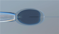 子宫卵巢全切后对乳腺有影响吗，最全科普都说全了！~高鹰国际助孕公司